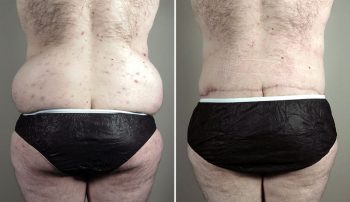 Body Lift and Tummy Tuck