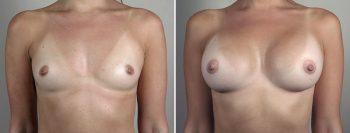 Breast Enlargement (Augmentation) Patient 100