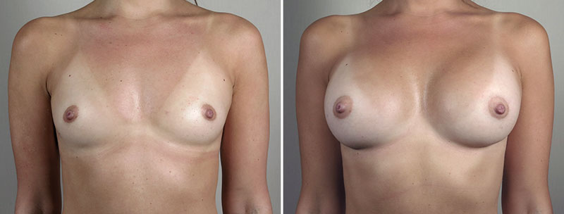 Breast Enlargement (Augmentation) Patient 100