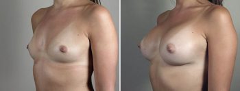 Breast Enlargement (Augmentation) Patient 100