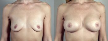Breast Enlargement (Augmentation) Patient 99