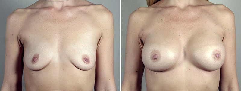 Breast Enlargement (Augmentation) Patient 99