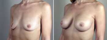 Breast Enlargement (Augmentation) Patient 99