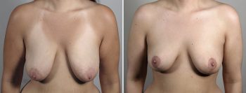 Breast Lift (Vertical Mastopexy) 18