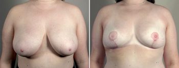 Breast Lift (Vertical Mastopexy) with Reduction Patient 18