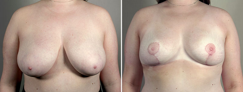 Breast Lift (Vertical Mastopexy) with Reduction Patient 18