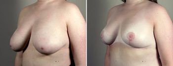 Breast Lift (Vertical Mastopexy) with Reduction Patient 18