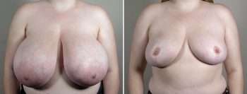 Breast Reduction with Lift 1