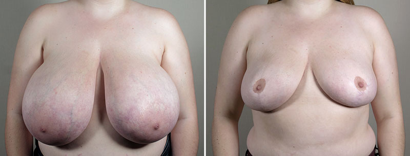 Breast Reduction with Lift 1