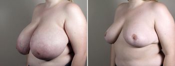 Breast Reduction with Lift 1