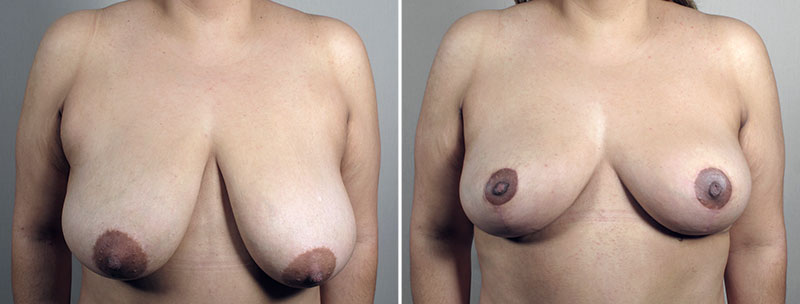 Breast Reduction with Lift 2