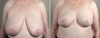 Breast Reduction with Lift 3