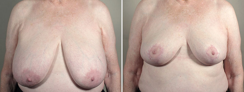 Breast Reduction with Lift 3