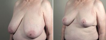 Breast Reduction with Lift 3