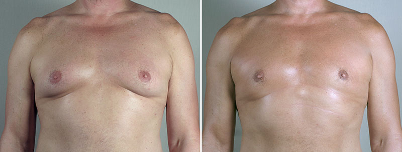 Gynecomastia Reduction Patient 60