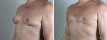 Gynecomastia Reduction Patient 60