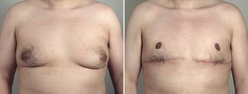Gynecomastia Reduction Patient 61