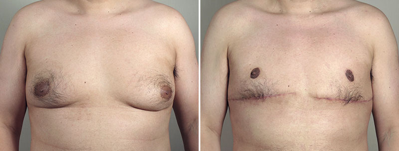 Gynecomastia Reduction Patient 61