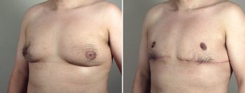 Gynecomastia Reduction Patient 61