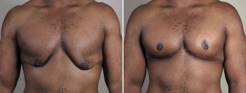 Gynecomastia Reduction Patient 62