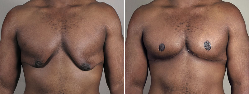 Gynecomastia Reduction Patient 62