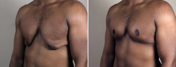 Gynecomastia Reduction Patient 62