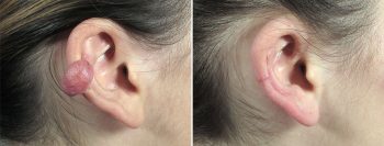 Keloid Treatment Patient 2