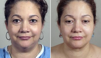 Neck Liposuction Patient 14