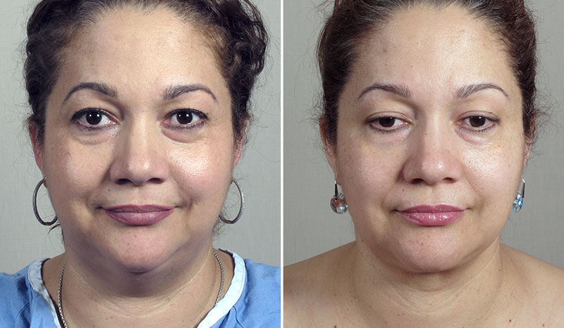 Neck Liposuction Patient 14