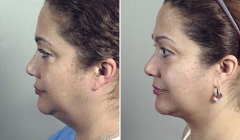 Neck Liposuction Patient 14