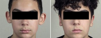 Otoplasty Patient 12