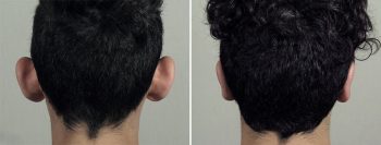 Otoplasty Patient 12