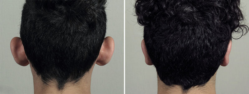 Otoplasty Patient 12