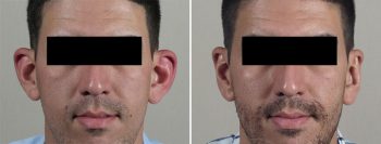 Otoplasty Patient 13