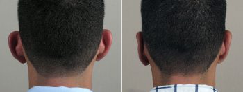 Otoplasty Patient 13