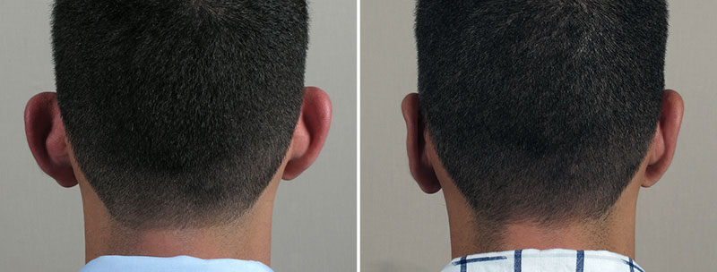 Otoplasty Patient 13