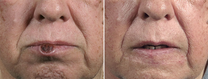 Skin Cancer Treatment Patient 56