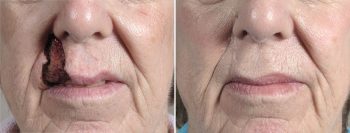 Skin Cancer Treatment Patient 57