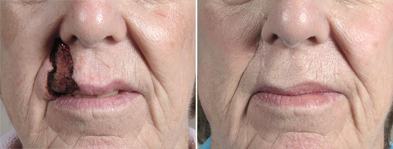 Skin Cancer Treatment Patient 57