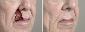 Skin Cancer Treatment Patient 57