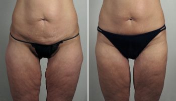 Thigh Lifting Surgery 14