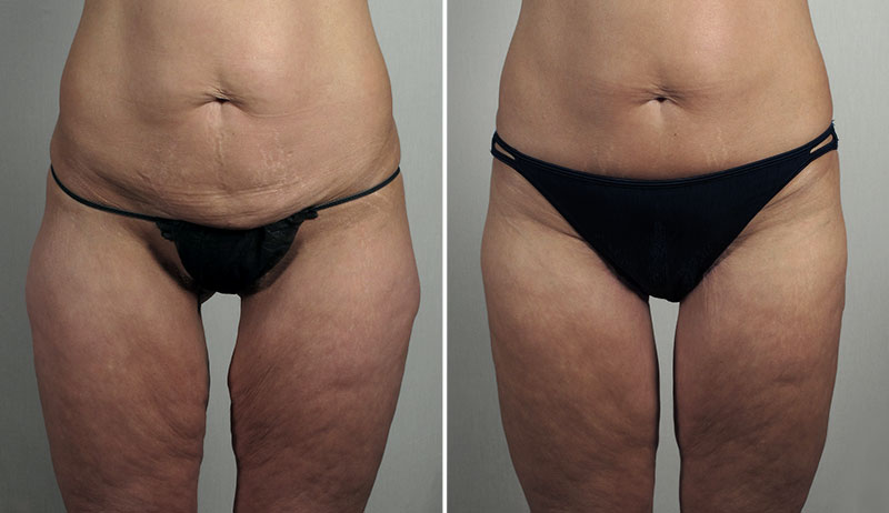 Thigh Lifting Surgery 14