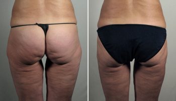 Thigh Lifting Surgery 14