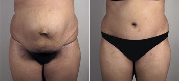 Parker Tummy Tuck Patient 59