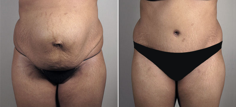 Parker Tummy Tuck Patient 59