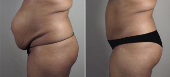 Parker Tummy Tuck Patient 59