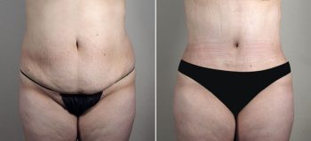 Parker Tummy Tuck Patient 58