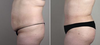 Parker Tummy Tuck Patient 58