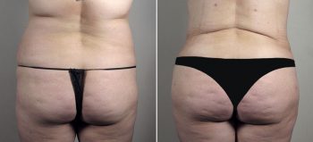 Parker Tummy Tuck Patient 58