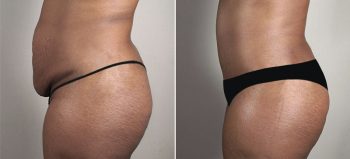 Parker Tummy Tuck Patient 57